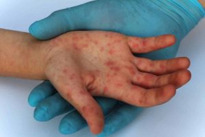 Read more about the article A fost confirmat primul caz de variola maimuţei în România
