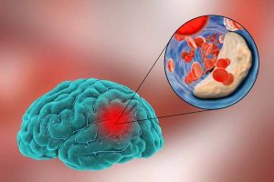 Read more about the article Studiu: Cazurile de accident vascular cerebral au crescut cu 70% în ultimii 30 de ani