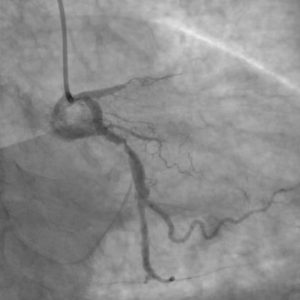 Read more about the article Avertisment al cardiologului târgoviștean Țoni Ovidiu: Stenturile se pot înfunda. Tratamentul nu se întrerupe niciodată!