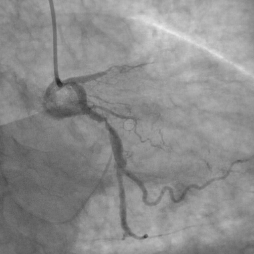 You are currently viewing Avertisment al cardiologului târgoviștean Țoni Ovidiu: Stenturile se pot înfunda. Tratamentul nu se întrerupe niciodată!