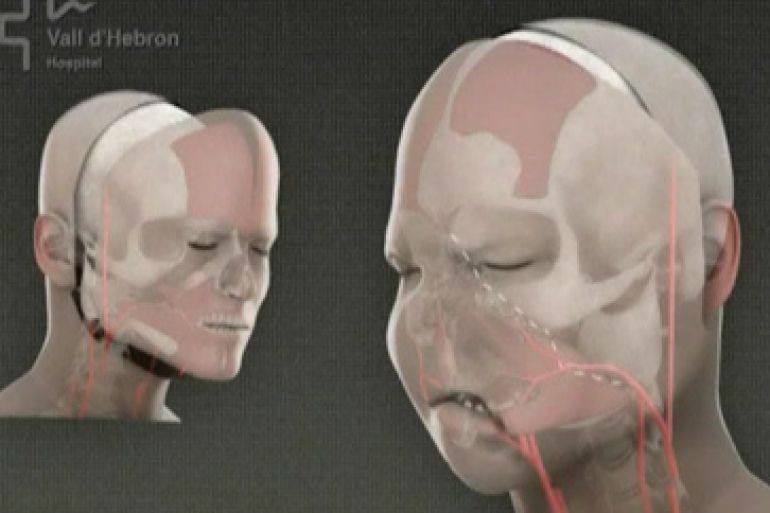 You are currently viewing Medicii din Spania au efectuat primul transplant facial din lume de la un donator care a solicitat moartea asistată